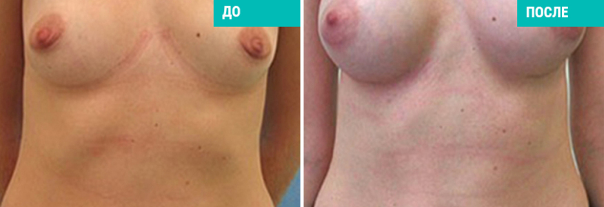Увеличение груди
