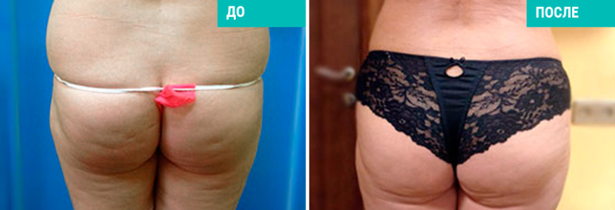 Липосакция