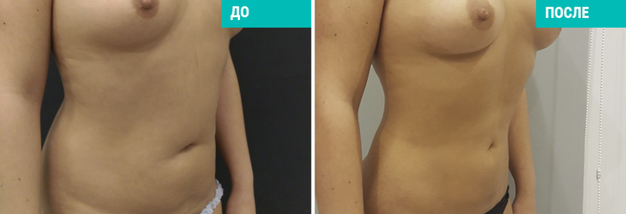 Vaser-липосакция