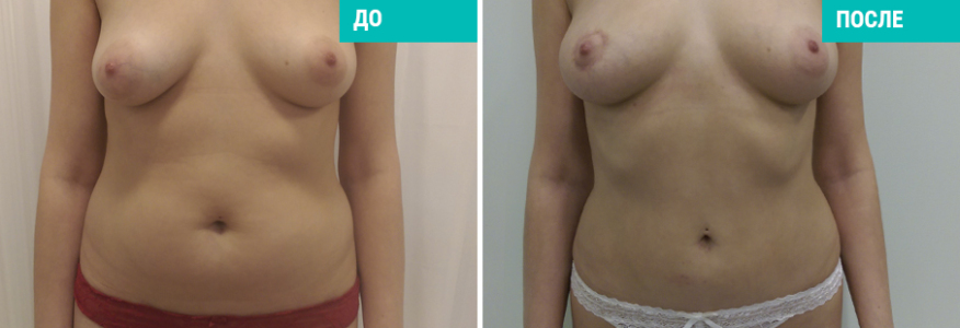 Vaser-липосакция