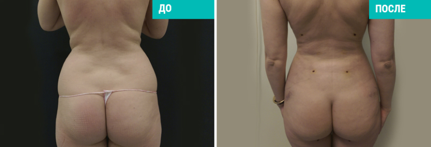 Vaser-липосакция