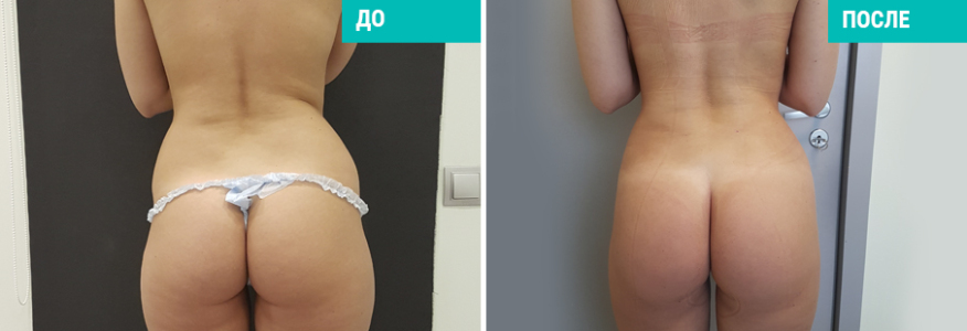 Vaser-липосакция