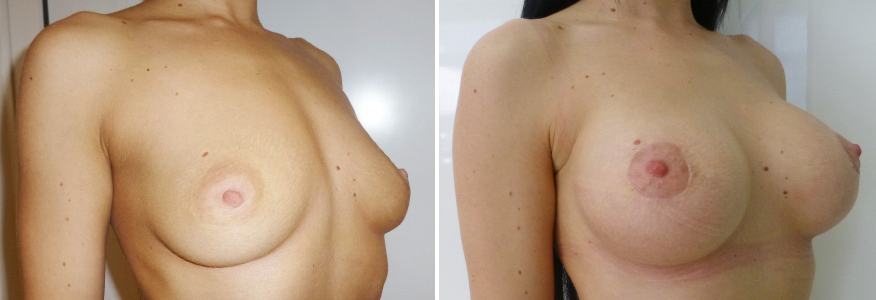 Маммопластика