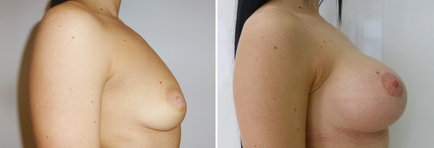 Маммопластика