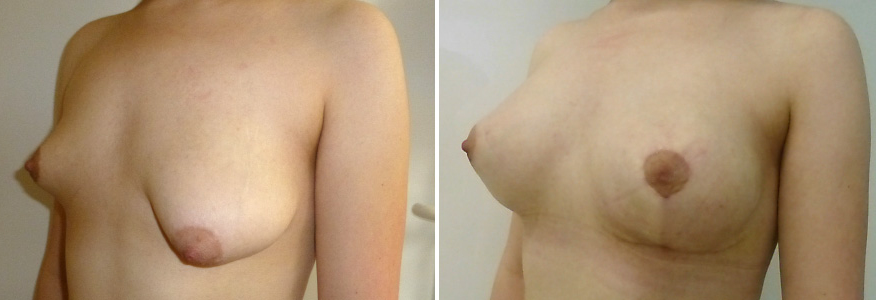 Маммопластика