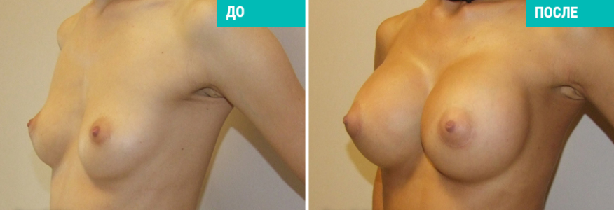 Увеличение груди