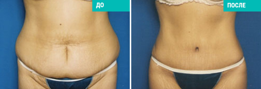 Абдоминопластика