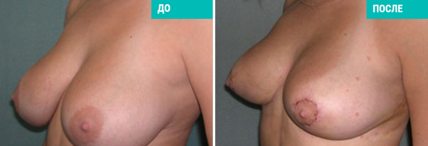 Подтяжка груди