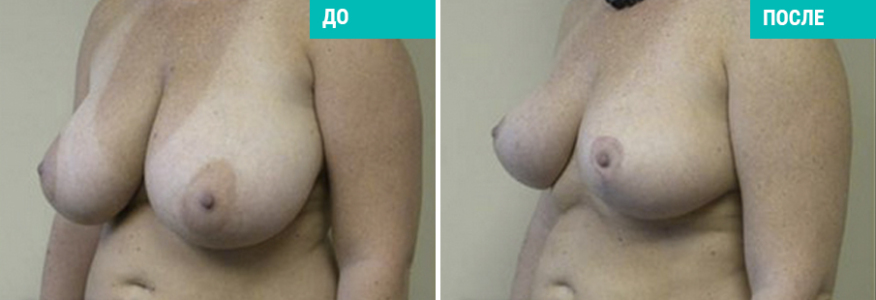 Уменьшение груди