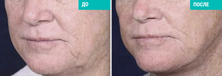 Нитевая подтяжка лица и шеи