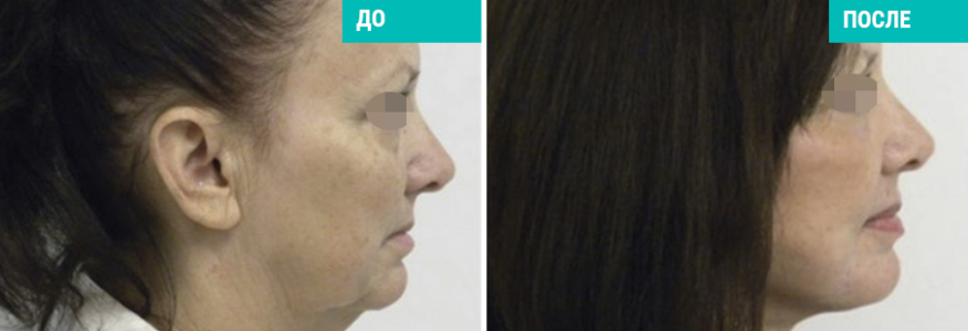 Фейслифтинг