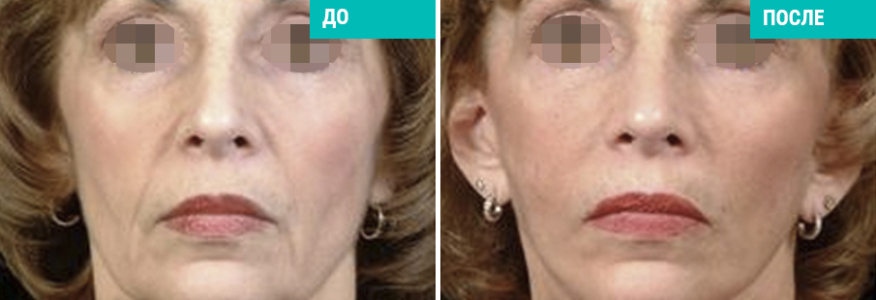 Фейслифтинг