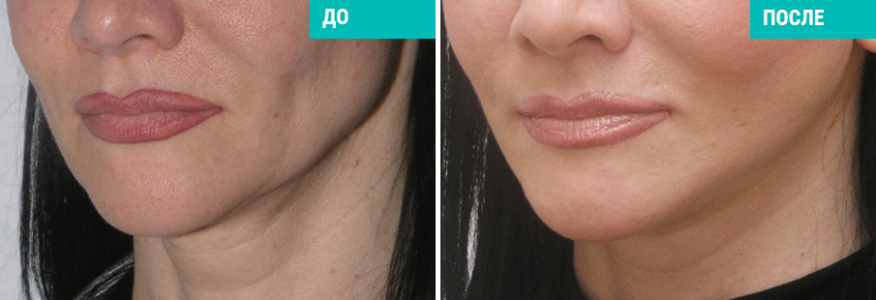 Подтяжка лица и шеи