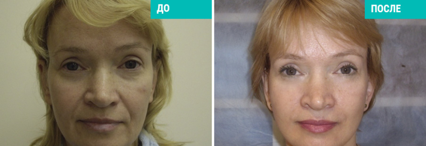 Подтяжка нити силуэт лифт