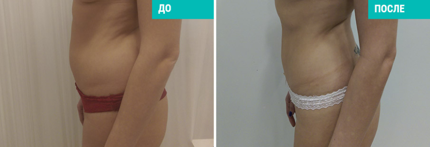 Вейзер липосакция