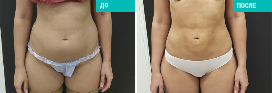 Вейзер липосакция