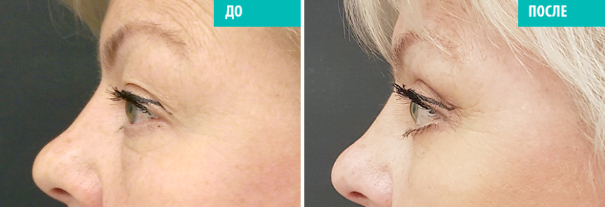 Блефаропластика