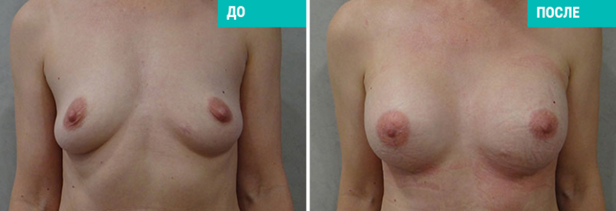 Увеличение груди