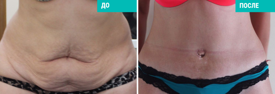 Абдоминопластика