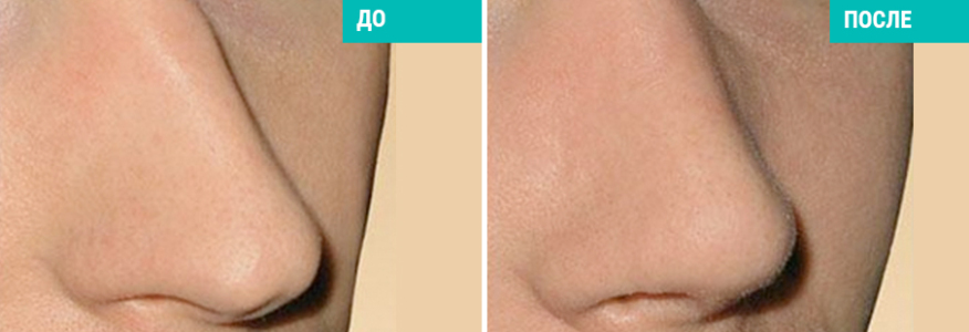 Ринопластика