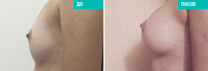 Увеличение груди