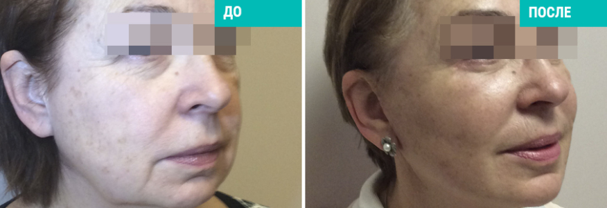 Triple S-lifting (3S-лифтинг)