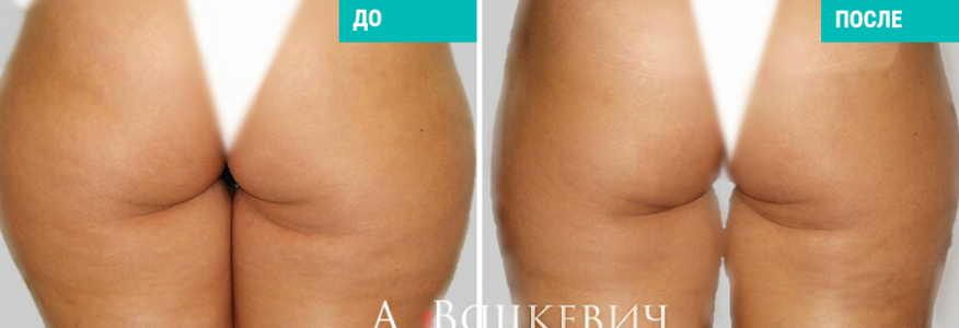 Липосакция 