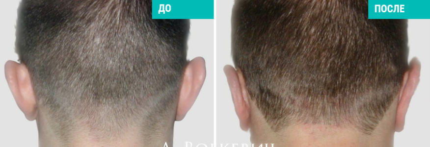 Отопластика