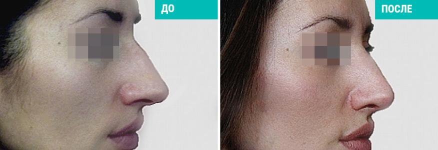 Ринопластика