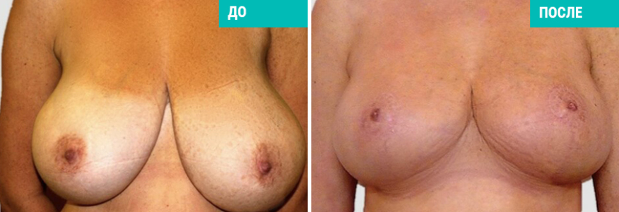 Уменьшение груди