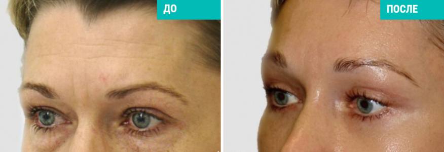 Эндоскопический лобно-височный лифтинг