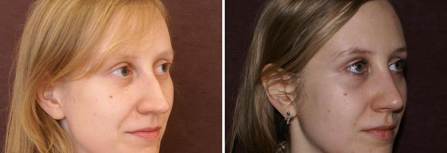 Ринопластика