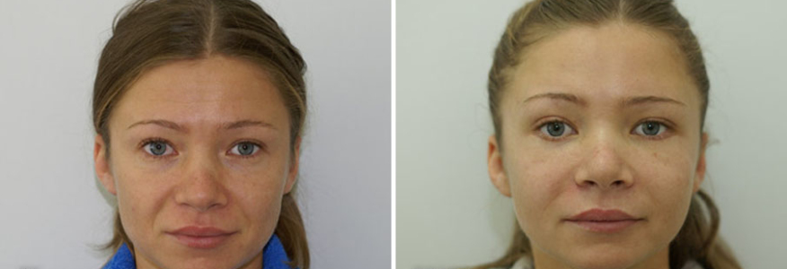 Эндоскопическая подтяжка лица