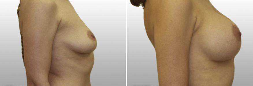 Увеличение груди