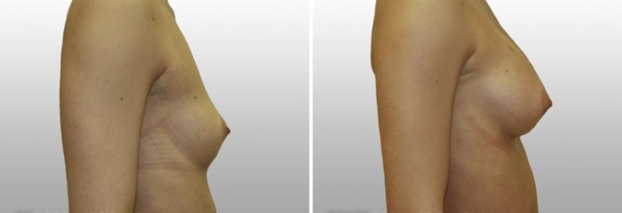Увеличение груди
