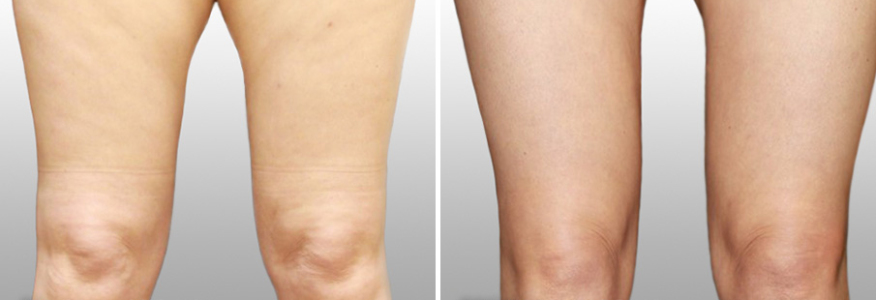 Липосакция