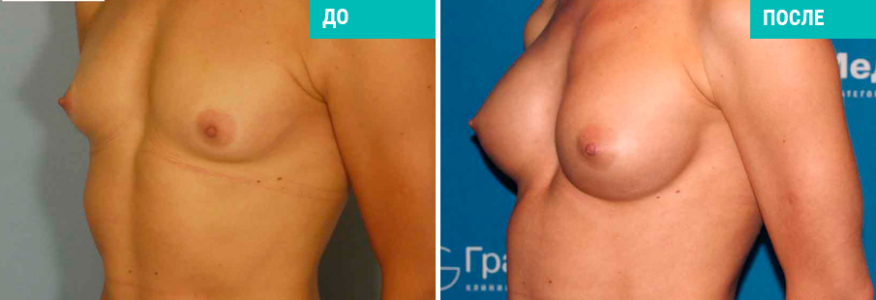 Увеличение груди