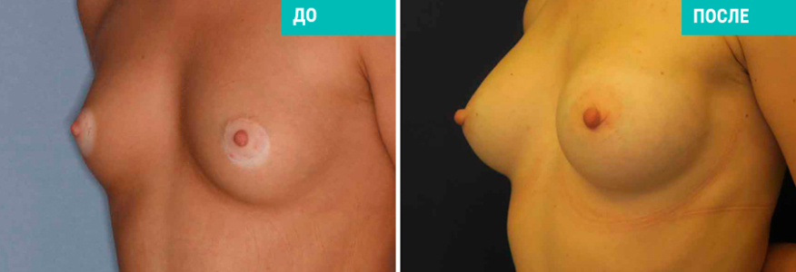 Увеличение груди