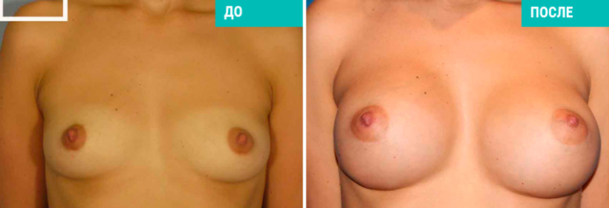 Увеличение груди