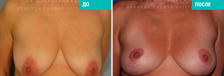 Увеличение груди