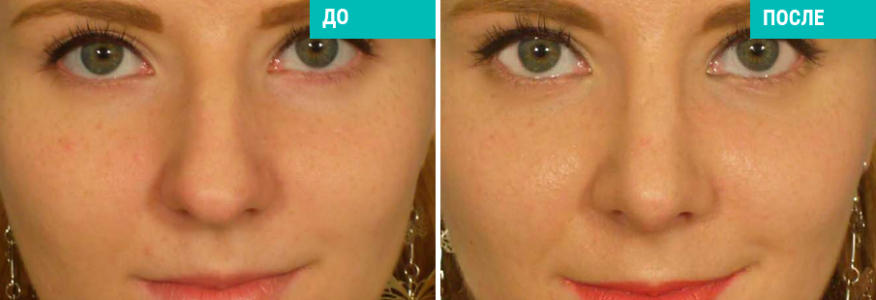 Ринопластика