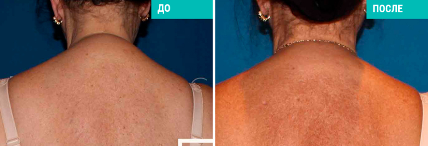 Липосакция