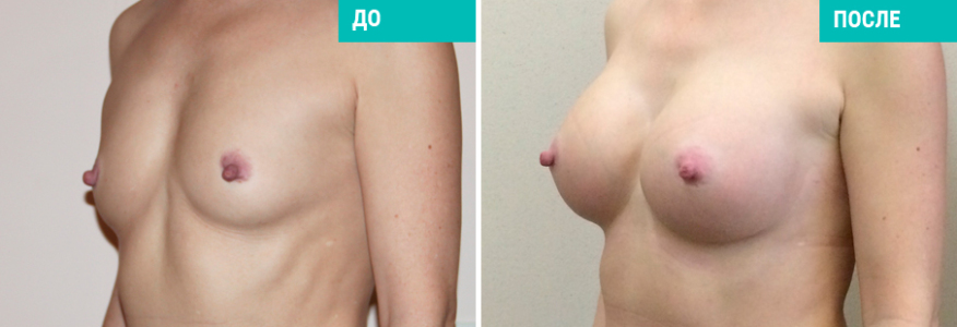 Увеличение груди