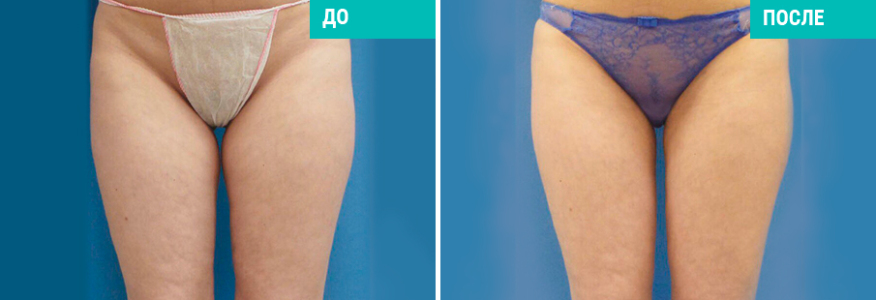 Липосакция