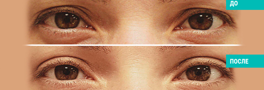 Блефаропластика