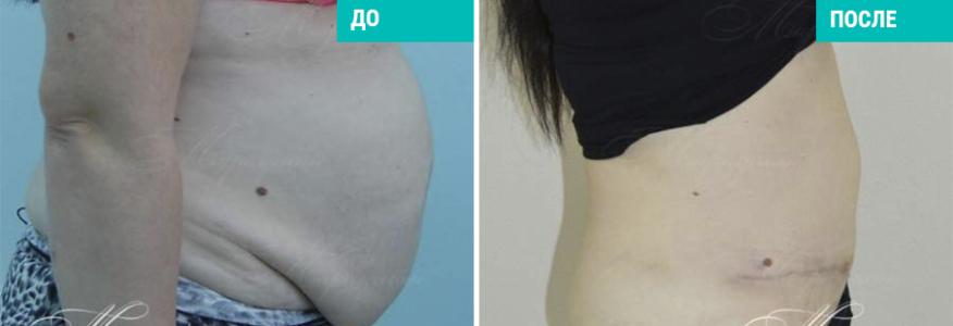 Абдоминопластика полная с липосакцией