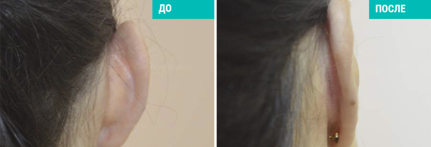 Отопластика