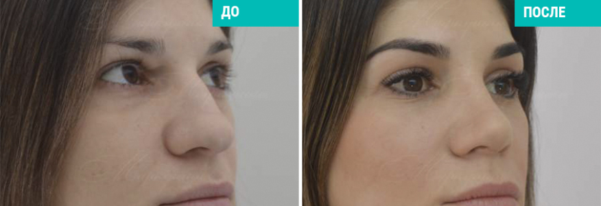 Риносептопластика