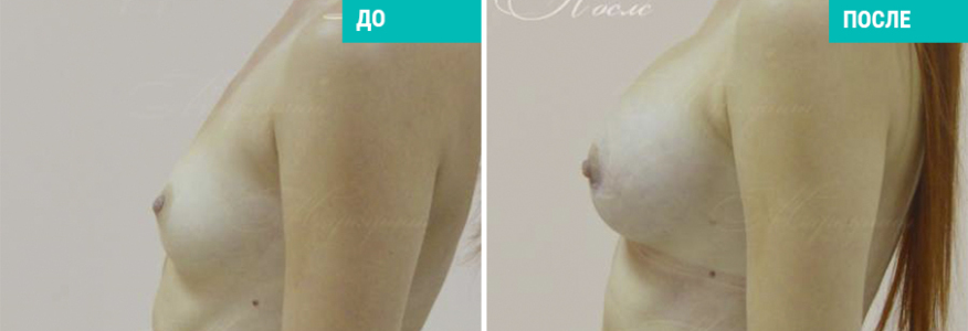 Увеличение груди
