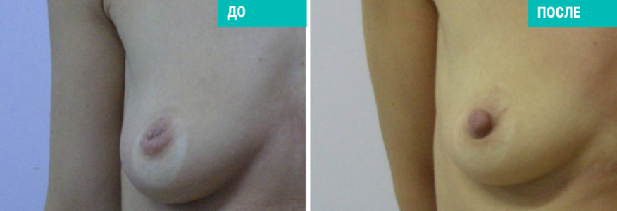 Втянутые соски